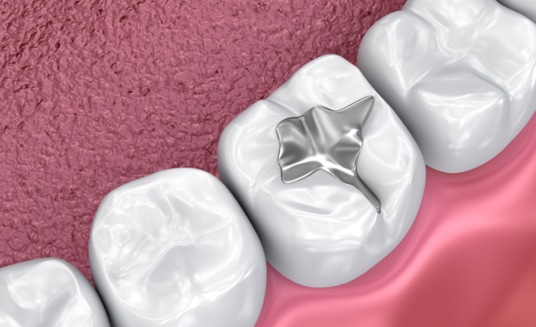 Dental Sealants in Lincoln, KS